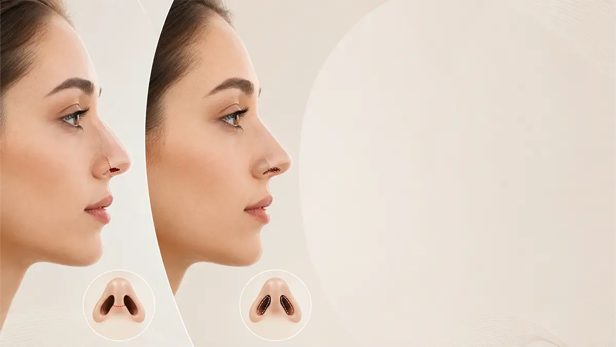 تفاوت عمل بینی باز و بسته چیست و هر روش چه کاربردی دارد؟